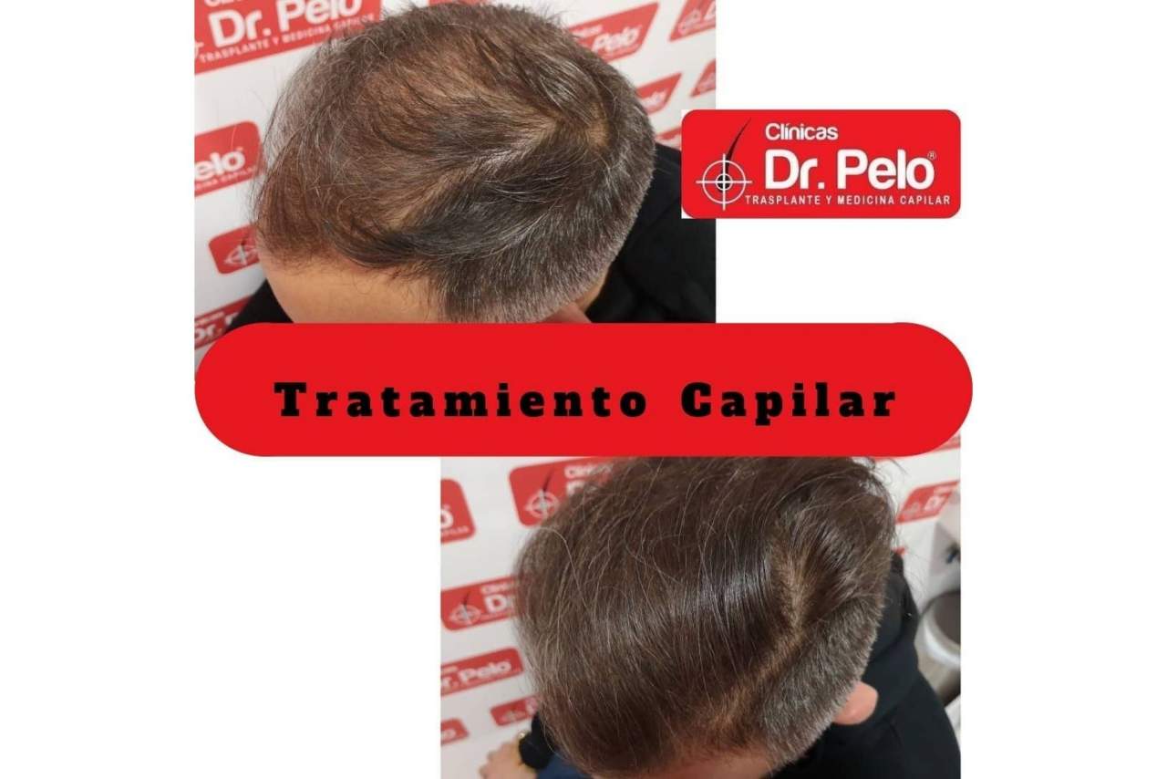 ¿Qué opinan los clientes sobre el injerto capilar de las Clínicas Dr. Pelo en Sevilla?