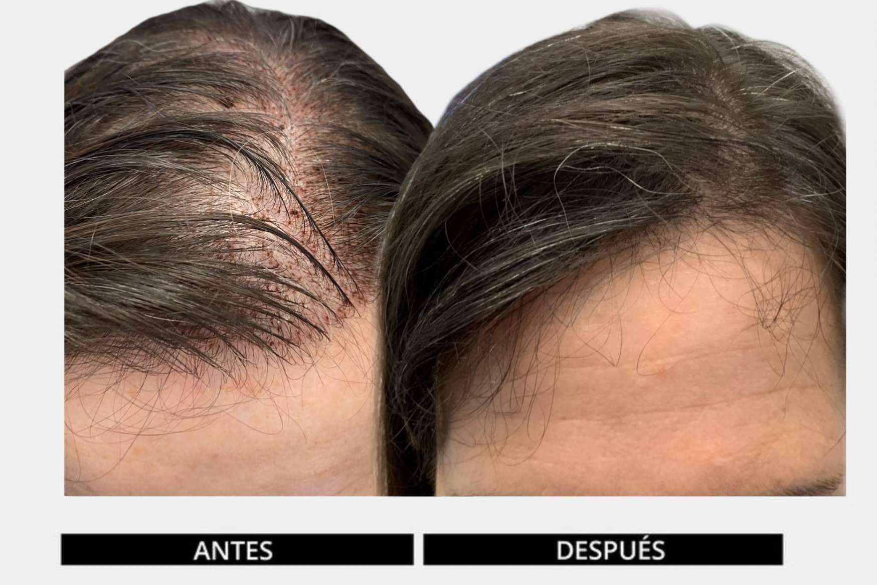 La clave del éxito de los tratamientos con el método DHI es la dedicación, la cual consigue retrasar el efecto de la calvicie